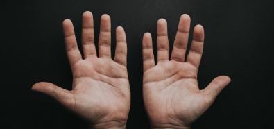 Egzema na dłoniach — poznaj podstawy pielęgnacji
