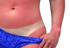 Oparzenia słoneczne - jak ratować skórę?