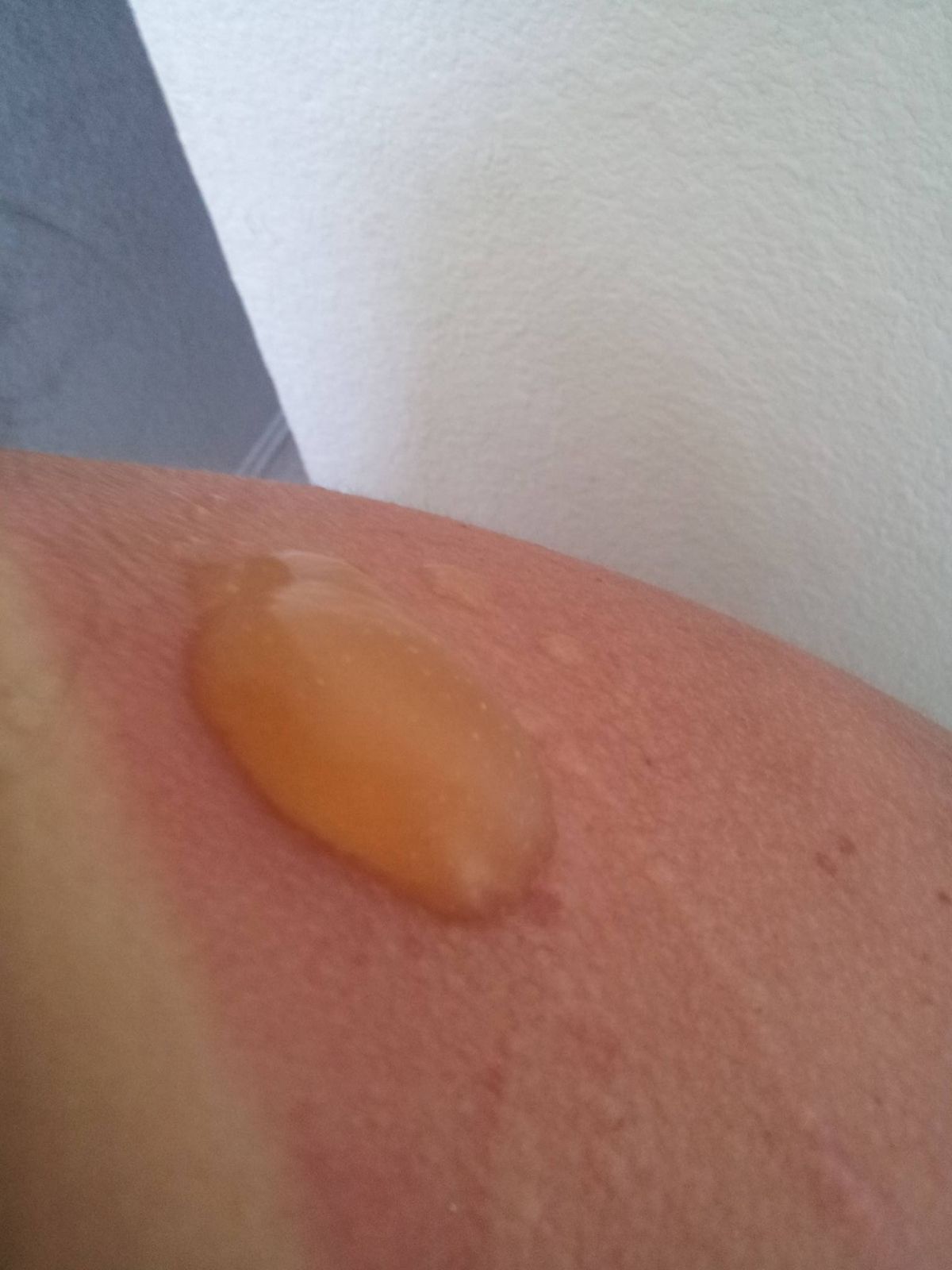 Oparzenia słoneczne - jak ratować skórę?